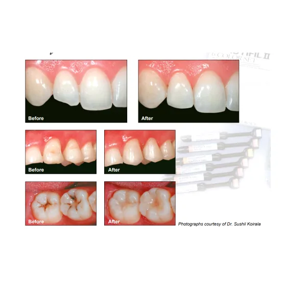 Shofu Beautifil II Dental Composite Basic Kit