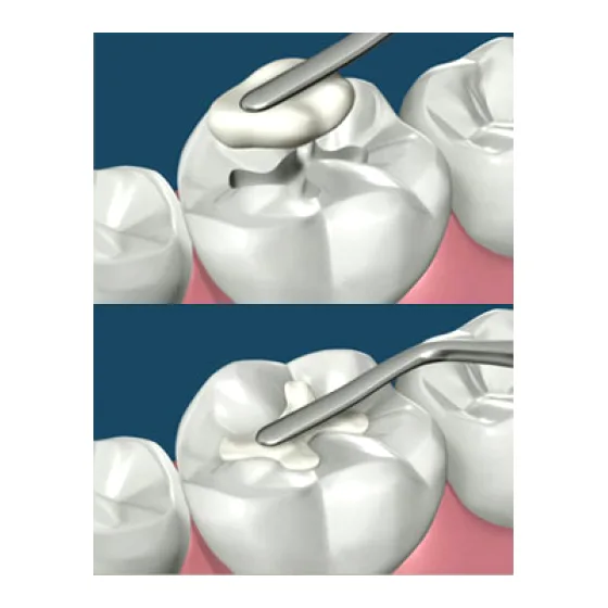 Dentsply Spectrum Composite Kit